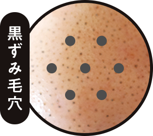 黒ずみ毛穴