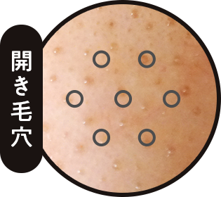 開き毛穴