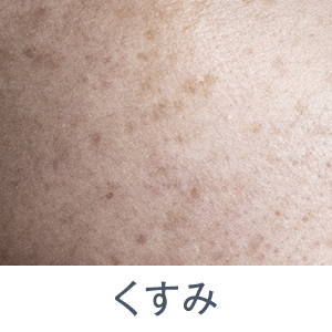 シミ・くすみ